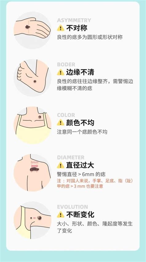 大痦子|痣也可能会癌变！长在 3 个地方要注意